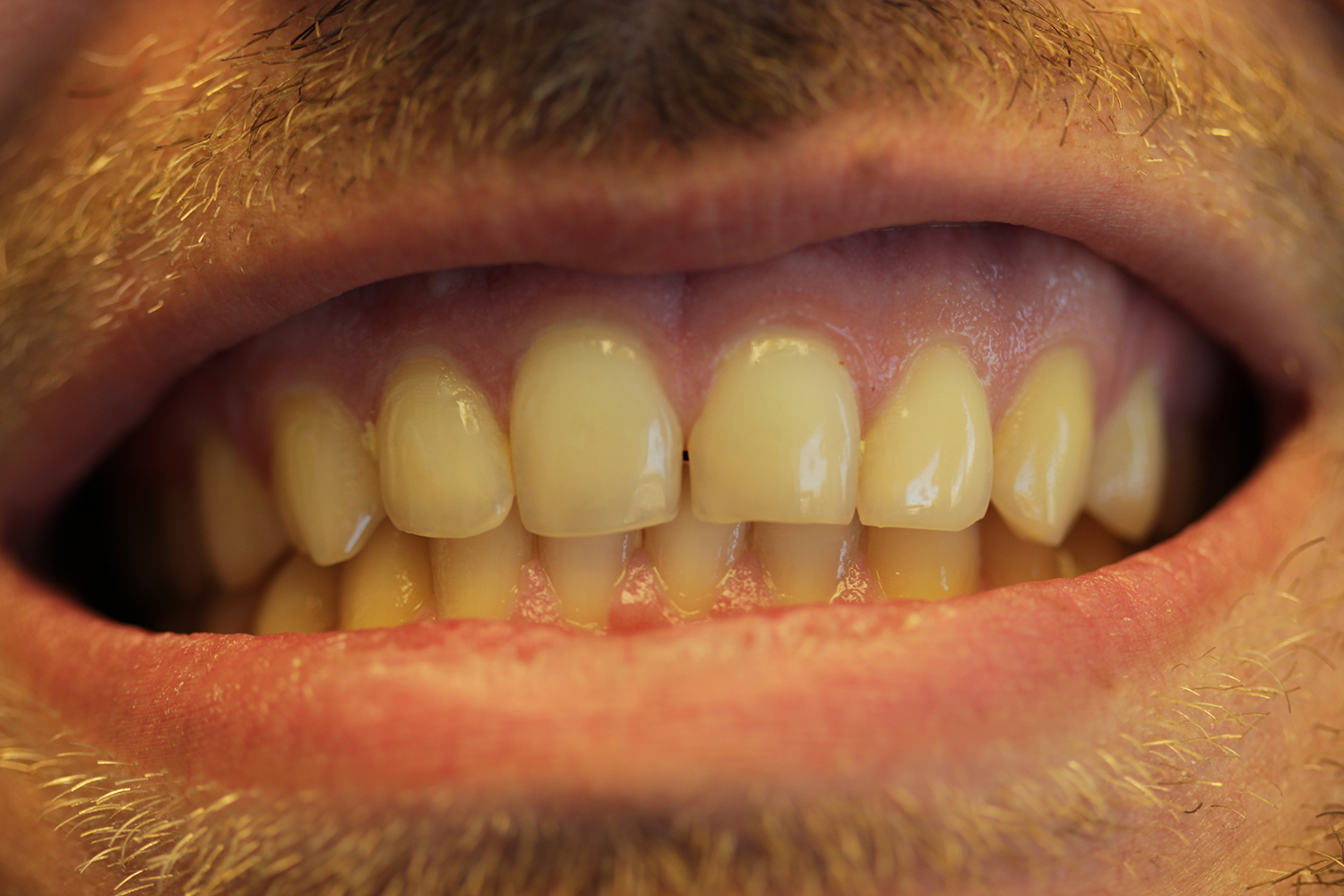 unwhitened teeth